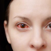 Woman with eye infection